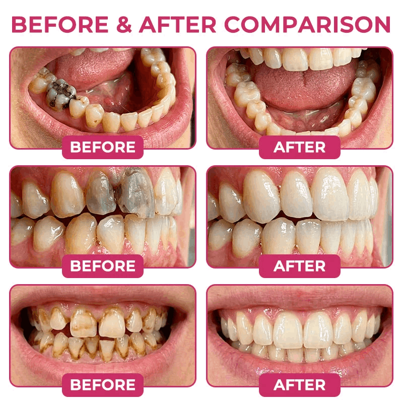 🦷🦢Healrize® Cavity-Repair Natural Enamel Filling Gel