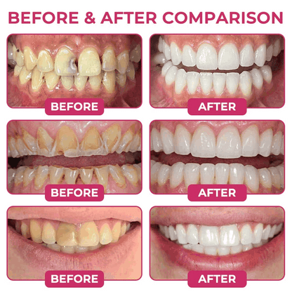 🦷🦢Healrize® Cavity-Repair Natural Enamel Filling Gel